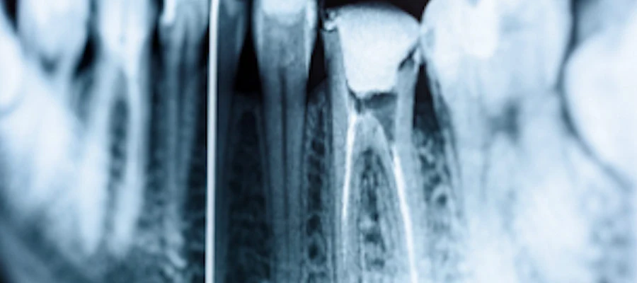 endodonzia